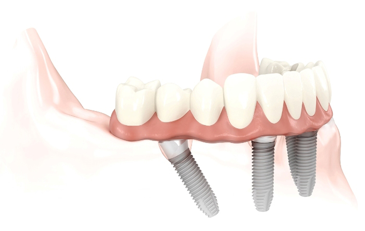 Dental implant